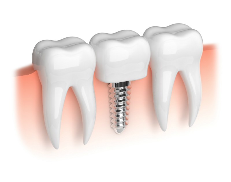 Seeking Affordable Dentures in Charleston SC