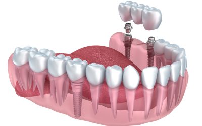 Dental Crowns Near Madison, WI: A Comprehensive Guide to Restoring Your Smile