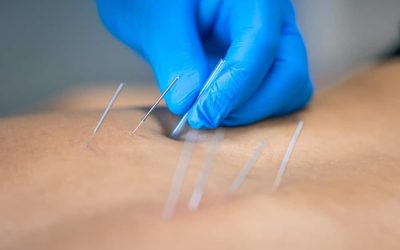 Relieve chronic pain and stress with acupuncture near Brighton CO for a healthier lifestyle
